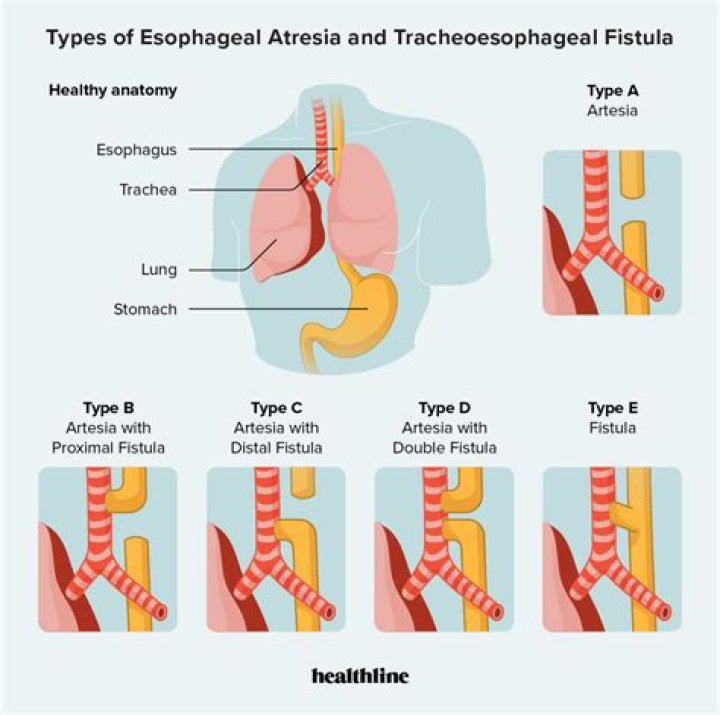 Esophageal Illness & Health Issues Detailed!