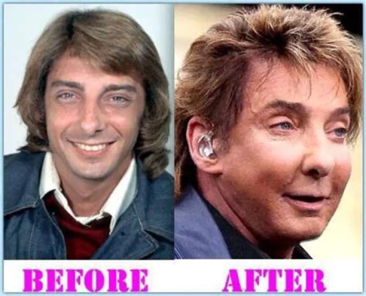 How Much Plastic Surgery Has Barry Manilow Had?
